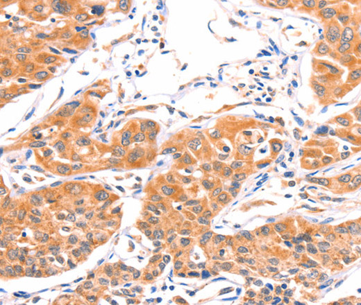 Immunohistochemistry of paraffin-embedded Human lung cancer using AMPD1 Polyclonal Antibody at dilution of 1:80