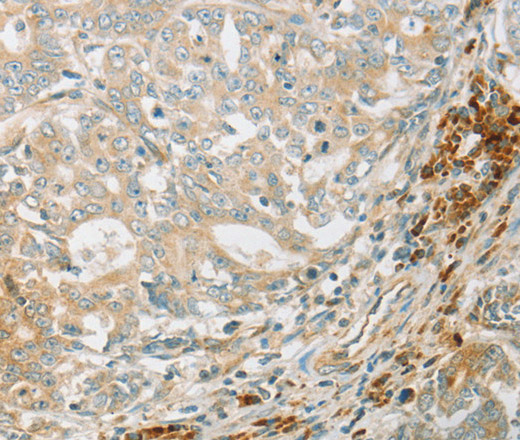 Immunohistochemistry of paraffin-embedded Human gastric cancer tissue using AMPK alpha1 Polyclonal Antibody at dilution 1:70