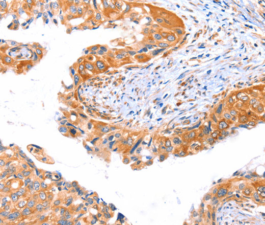 Immunohistochemistry of paraffin-embedded Human cervical cancer tissue using AP1B1 Polyclonal Antibody at dilution 1:70