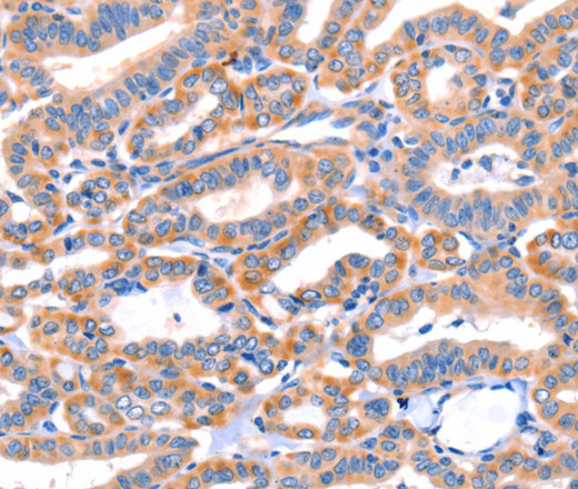 Immunohistochemistry of paraffin-embedded Human thyroid cancer tissue using AP1B1 Polyclonal Antibody at dilution 1:70