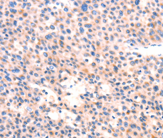 Immunohistochemistry of paraffin-embedded Human liver cancer tissue using APBA2 Polyclonal Antibody at dilution 1:80