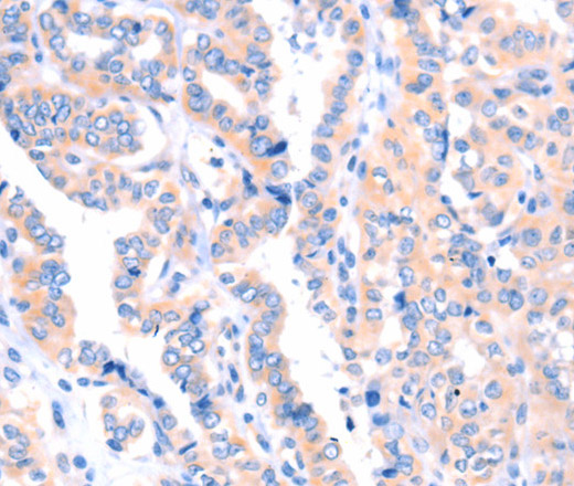 Immunohistochemistry of paraffin-embedded Human thyroid cancer tissue using APBA2 Polyclonal Antibody at dilution 1:80