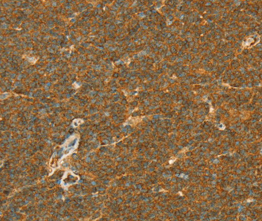 Immunohistochemistry of paraffin-embedded Human lymphoma using APOL2 Polyclonal Antibody at dilution of 1:80