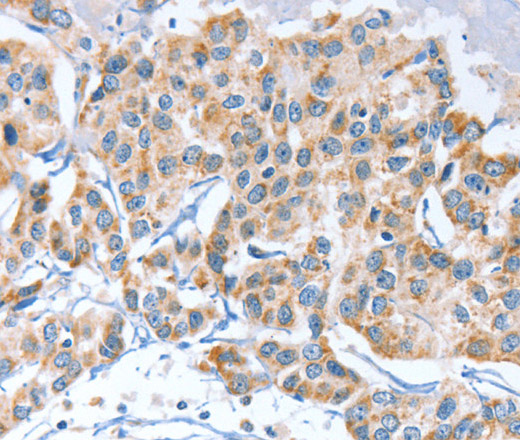 Immunohistochemistry of paraffin-embedded Human breast cancer using APOBEC3D Polyclonal Antibody at dilution of 1:80