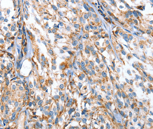 Immunohistochemistry of paraffin-embedded Human esophagus cancer using APOBEC3D Polyclonal Antibody at dilution of 1:80