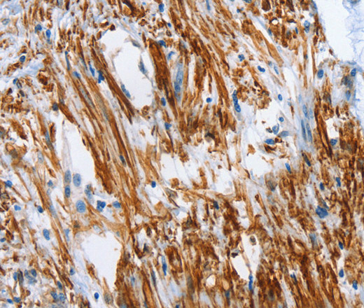 Immunohistochemistry of paraffin-embedded Human colon cancer tissue using SHROOM2 Polyclonal Antibody at dilution 1:50