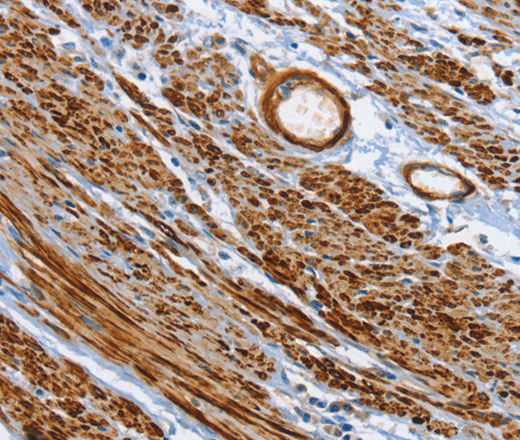 Immunohistochemistry of paraffin-embedded Human cervical cancer tissue using SHROOM2 Polyclonal Antibody at dilution 1:50