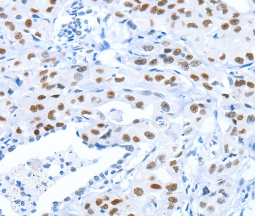 Immunohistochemistry of paraffin-embedded Human lung cancer tissue using ARID1A Polyclonal Antibody at dilution 1:80