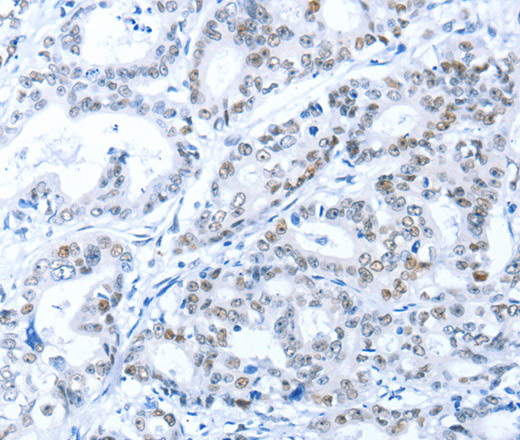 Immunohistochemistry of paraffin-embedded Human gastric cancer tissue using ARID1A Polyclonal Antibody at dilution 1:80