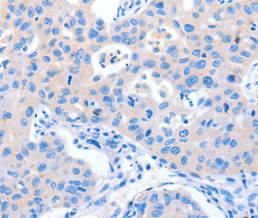 Immunohistochemistry of paraffin-embedded Human lung cancer tissue using NUAK1 Polyclonal Antibody at dilution 1:60