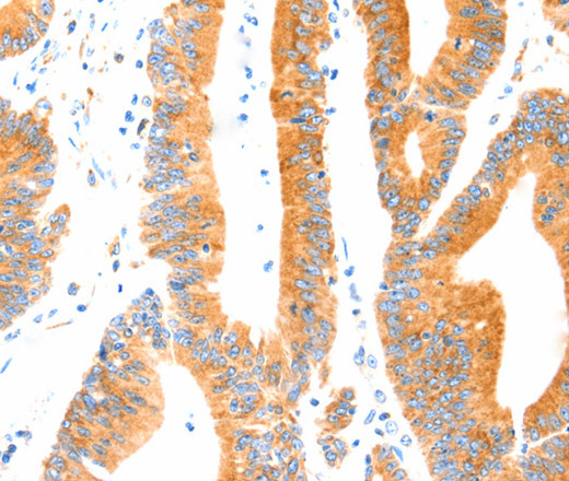 Immunohistochemistry of paraffin-embedded Human colon cancer tissue using MANF Polyclonal Antibody at dilution 1:70