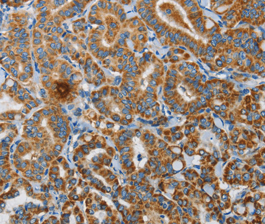 Immunohistochemistry of paraffin-embedded Human thyroid cancer using UPF1 Polyclonal Antibody at dilution of 1:35