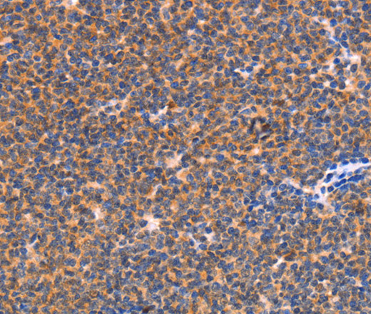 Immunohistochemistry of paraffin-embedded Human lymphoma tissue using NES Polyclonal Antibody at dilution 1:30