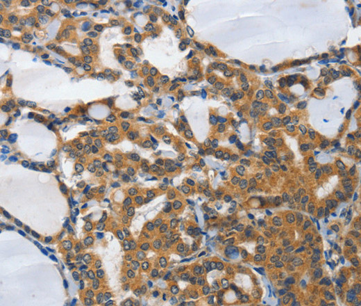 Immunohistochemistry of paraffin-embedded Human thyroid cancer tissue using PIAS2 Polyclonal Antibody at dilution 1:70