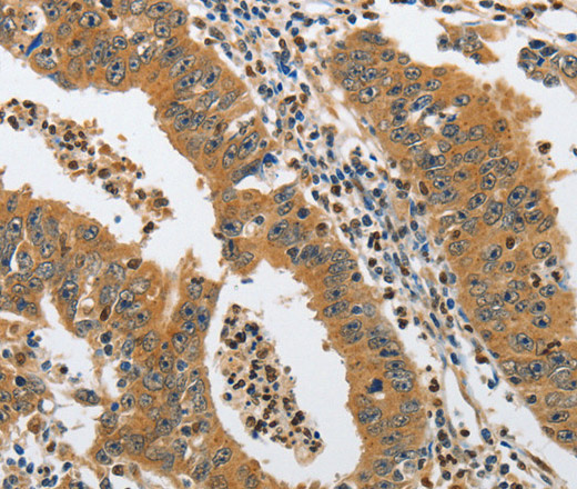 Immunohistochemistry of paraffin-embedded Human gastric cancer tissue using PIK3R3 Polyclonal Antibody at dilution 1:45