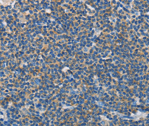 Immunohistochemistry of paraffin-embedded Human lymphoma tissue using NEK5 Polyclonal Antibody at dilution 1:60