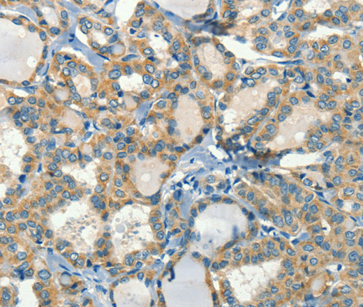 Immunohistochemistry of paraffin-embedded Human thyroid cancer tissue using CALCA Polyclonal Antibody at dilution 1:60