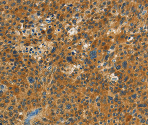 Immunohistochemistry of paraffin-embedded Human liver cancer tissue using NPAP1 Polyclonal Antibody at dilution 1:60