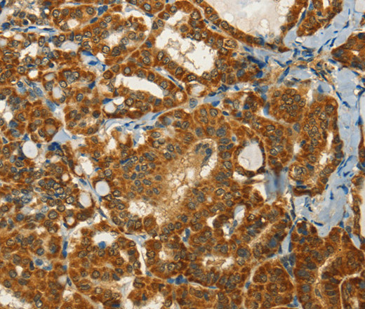 Immunohistochemistry of paraffin-embedded Human thyroid cancer tissue using NPAP1 Polyclonal Antibody at dilution 1:60