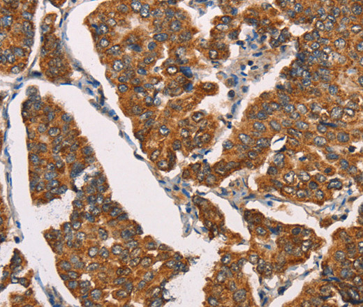 Immunohistochemistry of paraffin-embedded Human breast cancer using SPR Polyclonal Antibody at dilution of 1:40