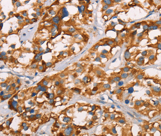 Immunohistochemistry of paraffin-embedded Human thyroid cancer using SPR Polyclonal Antibody at dilution of 1:40