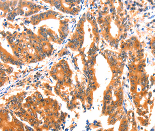 Immunohistochemistry of paraffin-embedded Human gasrtic cancer tissue using AK5 Polyclonal Antibody at dilution 1:60