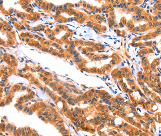 Immunohistochemistry of paraffin-embedded Human thyroid cancer tissue using AK5 Polyclonal Antibody at dilution 1:60