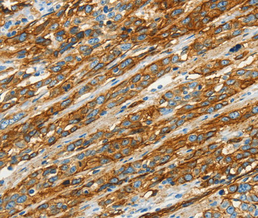 Immunohistochemistry of paraffin-embedded Human esophagus cancer using CAV1 Polyclonal Antibody at dilution of 1:40