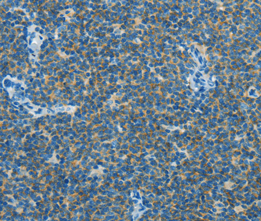 Immunohistochemistry of paraffin-embedded Human lymphoma using CAV3 Polyclonal Antibody at dilution of 1:30