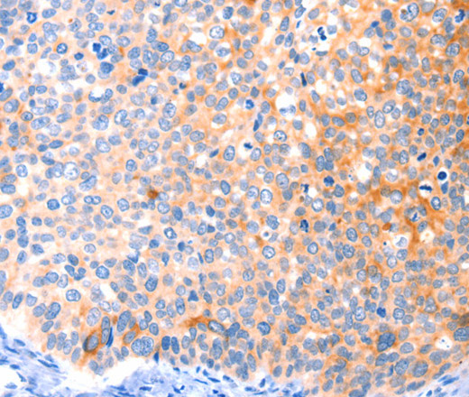 Immunohistochemistry of paraffin-embedded Human cervical cancer tissue using CCDC88A Polyclonal Antibody at dilution 1:50