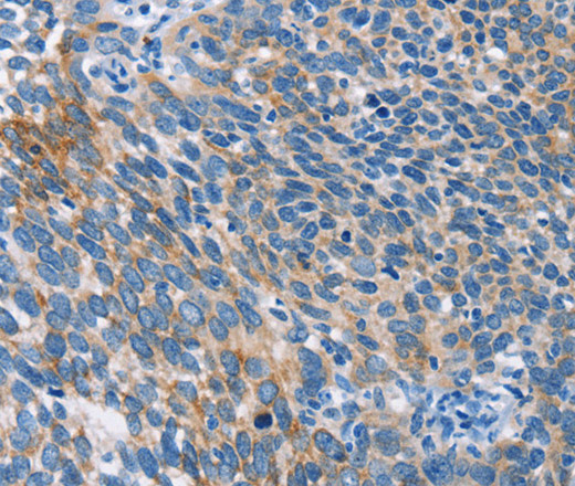 Immunohistochemistry of paraffin-embedded Human cervical cancer tissue using AHR Polyclonal Antibody at dilution 1:50