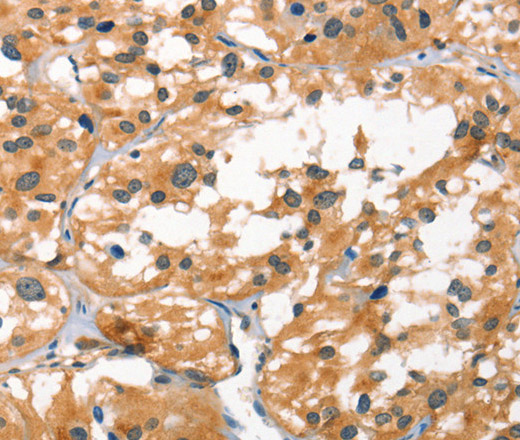 Immunohistochemistry of paraffin-embedded Human thyroid cancer using SMAD3 Polyclonal Antibody at dilution of 1:25