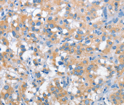 Immunohistochemistry of paraffin-embedded Human thyroid cancer tissue using SNCA Polyclonal Antibody at dilution 1:30