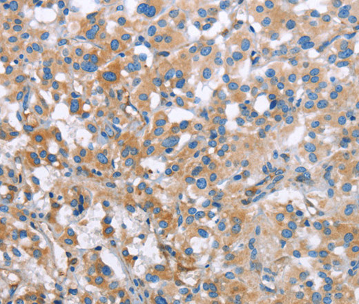 Immunohistochemistry of paraffin-embedded Human thyroid cancer tissue using MCL1 Polyclonal Antibody at dilution 1:60