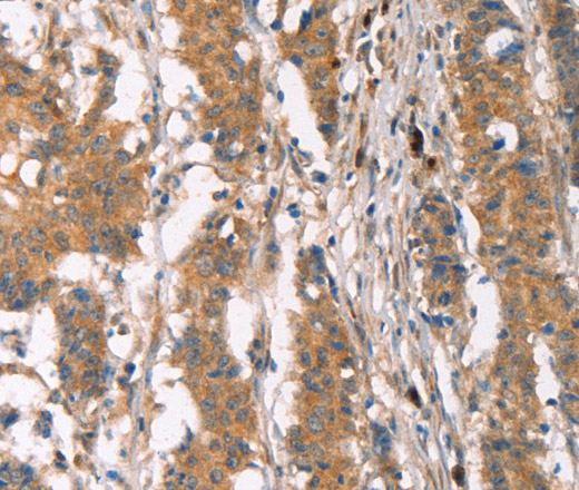 Immunohistochemistry of paraffin-embedded Human gastric cancer using PLIN2 Polyclonal Antibody at dilution of 1:30