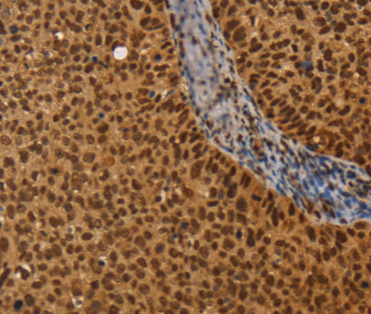 Immunohistochemistry of paraffin-embedded Human cervical cancer using CEL Polyclonal Antibody at dilution of 1:40