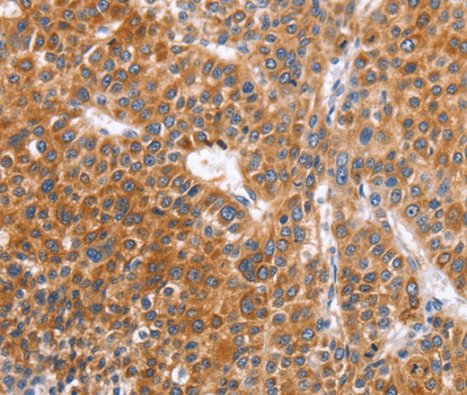 Immunohistochemistry of paraffin-embedded Human liver cancer tissue using ABO Polyclonal Antibody at dilution 1:50