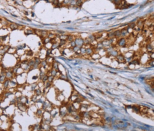 Immunohistochemistry of paraffin-embedded Human breast cancer using BMP6 Polyclonal Antibody at dilution of 1:50