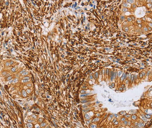 Immunohistochemistry of paraffin-embedded Human cervical cancer tissue using BRS3 Polyclonal Antibody at dilution 1:30