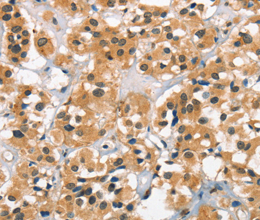 Immunohistochemistry of paraffin-embedded Human thyroid cancer tissue using Cav1.2 Polyclonal Antibody at dilution 1:30