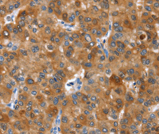 Immunohistochemistry of paraffin-embedded Human liver cancer tissue using NOD2 Polyclonal Antibody at dilution 1:40