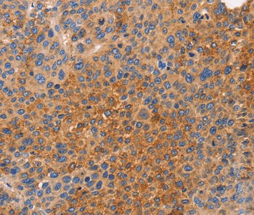 Immunohistochemistry of paraffin-embedded Human liver cancer tissue using NOD1 Polyclonal Antibody at dilution 1:50