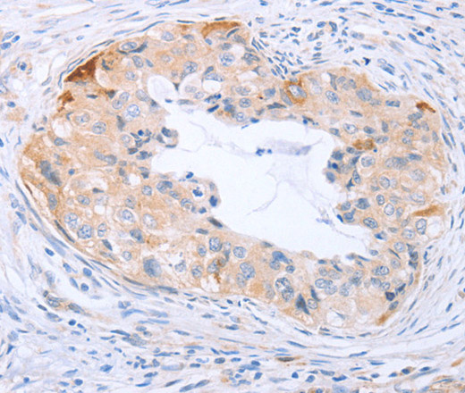 Immunohistochemistry of paraffin-embedded Human cervical cancer tissue using CARD6 Polyclonal Antibody at dilution 1:60