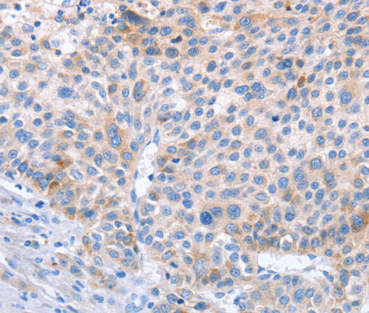 Immunohistochemistry of paraffin-embedded Human liver cancer using STK4 Polyclonal Antibody at dilution of 1:70