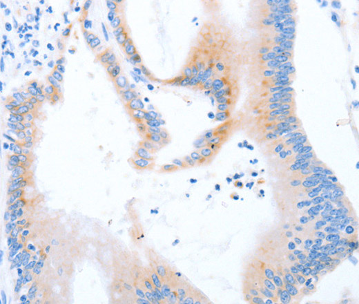 Immunohistochemistry of paraffin-embedded Human colon cancer using STK4 Polyclonal Antibody at dilution of 1:70