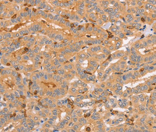 Immunohistochemistry of paraffin-embedded Human thyroid cancer tissue using CCL16  Polyclonal Antibody at dilution 1:60