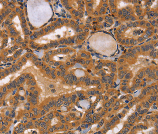 Immunohistochemistry of paraffin-embedded Human thyroid cancer tissue using CCL23 Polyclonal Antibody at dilution 1:50