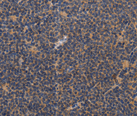 Immunohistochemistry of paraffin-embedded Human lymphoma tissue using CCL23 Polyclonal Antibody at dilution 1:50