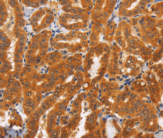 Immunohistochemistry of paraffin-embedded Human thyroid cancer tissue using TNFRSF8 Polyclonal Antibody at dilution 1:60