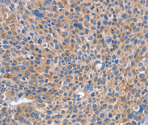 Immunohistochemistry of paraffin-embedded Human liver cancer using CD328 Polyclonal Antibody at dilution of 1:50